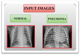 Pneumonia Prediction